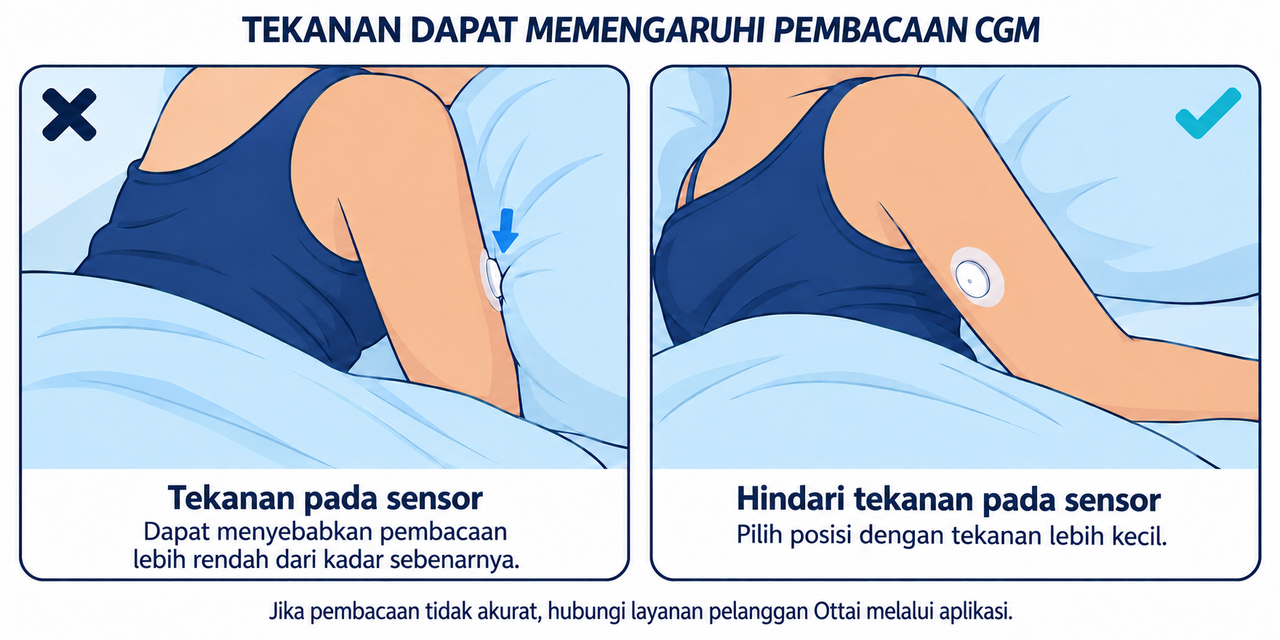 Hindari Menindih CGM Saat Tidur: Tekanan Dapat Memengaruhi Pembacaan